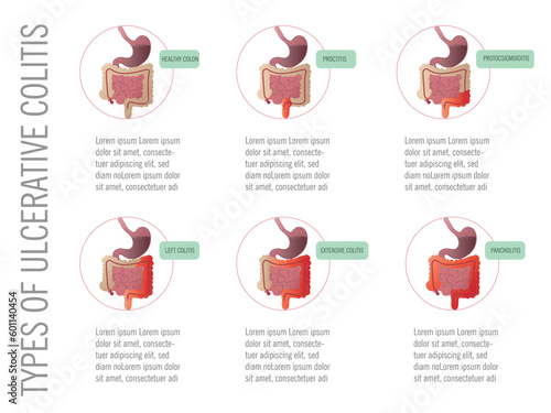 Infographic: types of ulcerative colitis according to the affected area
