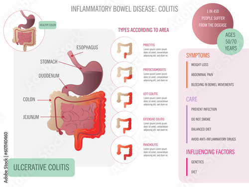 Infographic about ulcerative colitis types, symptoms, care with corresponding icons on white background photo