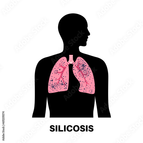 Silicosis dust in lung
