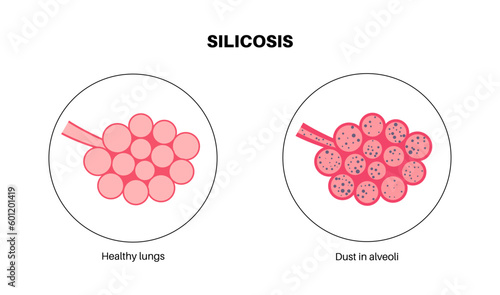 Silicosis dust in lung