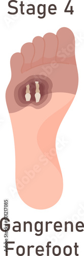 Gangrene Forefoot Disease