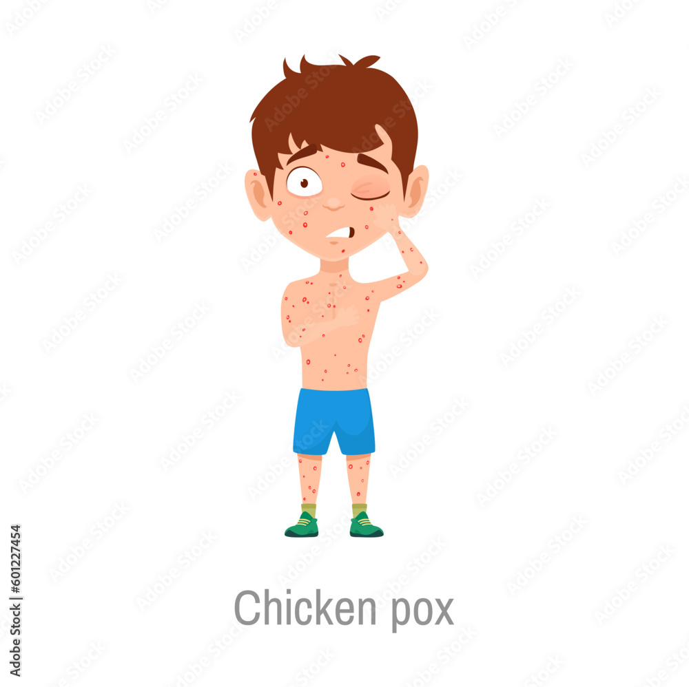 Chicken pox kid sickness, isolated vector sick boy with varicella, highly contagious disease caused by the initial infection with varicella zoster virus. Child with rash and red scratchy spots on body Chicken pox kid sickness, isolated vector sick boy with varicella, highly contagious disease caused by the initial infection with varicella zoster virus. Child with rash and red scratchy spots on body