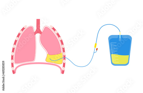 Thoracentesis medical procedure