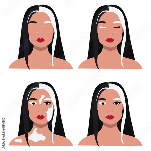 A set of cute stylized girls with partial albinism, piebaldism, and straight black and white hair. Call for solidarity with people suffering from albinism. Stylized black and white vector graphics