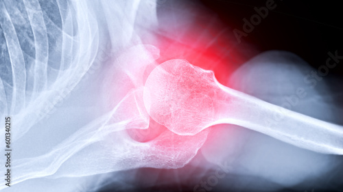 X-ray Shoulder joint shoulder transaxillary view for diagnosis fracture of shoulder joint. photo