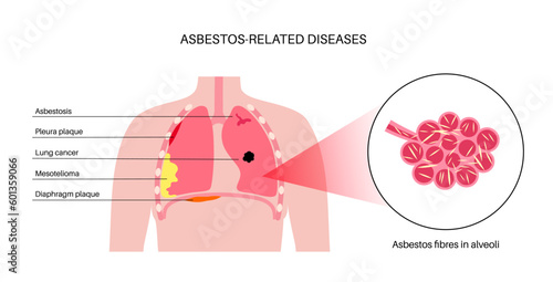 Asbestos related diseases