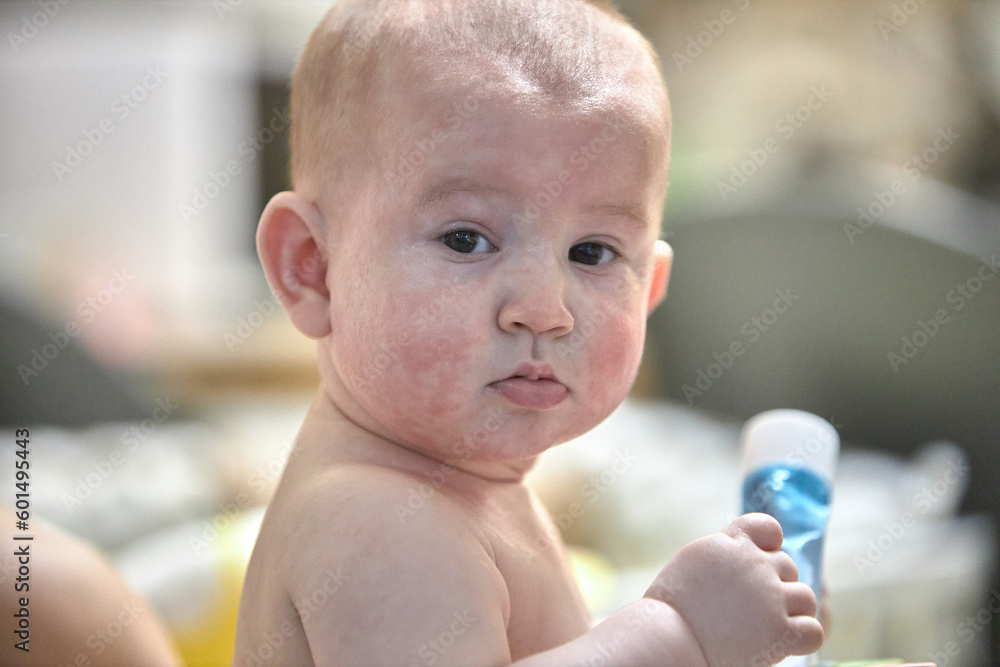 roseola rash a viral rash on the skin of a child Stock Photo | Adobe Stock