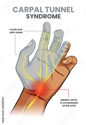 illustration of carpal tunnel syndrome with the numb area in hand
