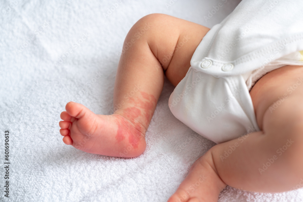 Hemangioma red birthmark on the leg of newborn baby Hemangioma red birthmark on the leg of newborn baby