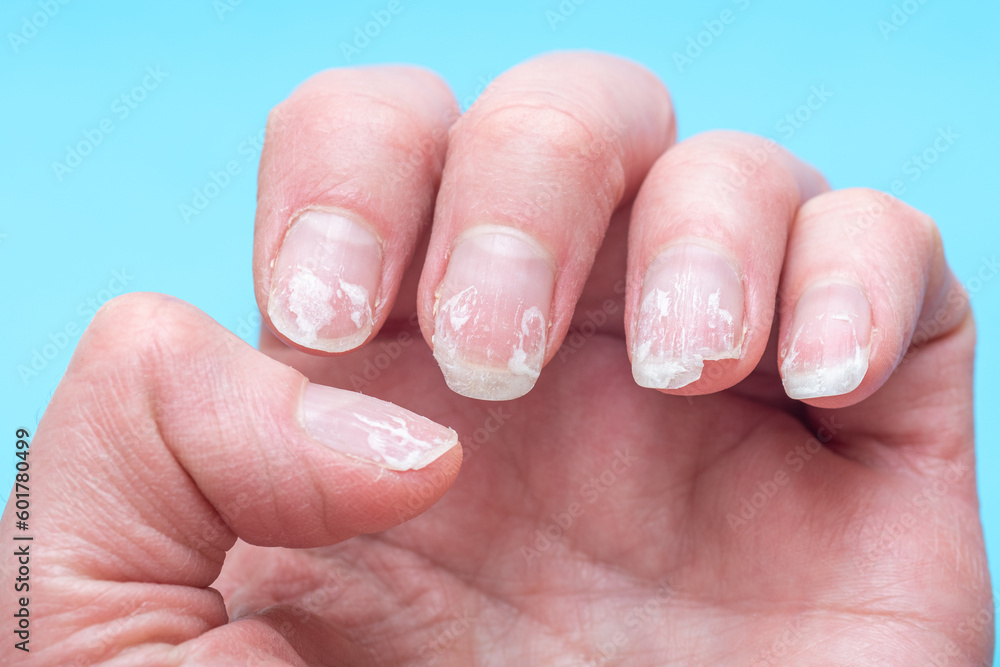 Flaky bitten and brittle nails without a manicure. Regrown nail cuticle and damaged nail plate after gel polish on blue background. - obrazy, fototapety, plakaty 