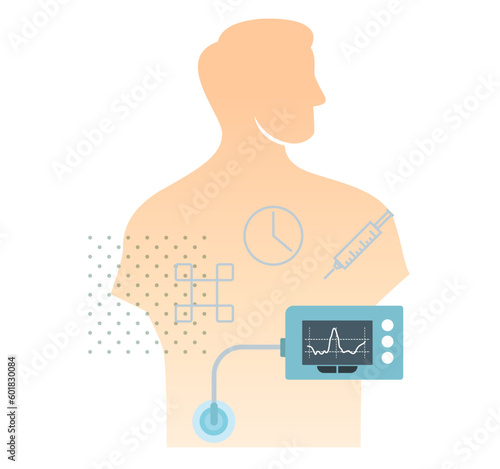 Insulin Pump for Diabetes - Stock Illustration