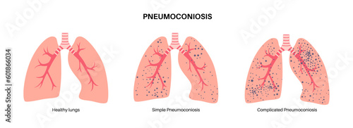 Pneumoconiosis lung disease