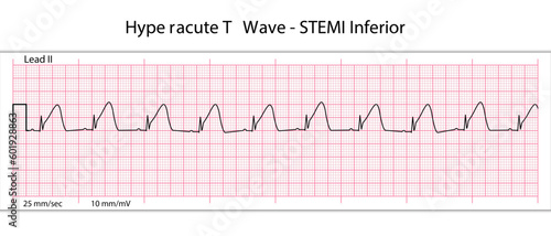 ECG Hyperacute STEMI - 8 Second ECG Paper - Peaked T Wave - Vectors and Illustrations for Medical Purposes