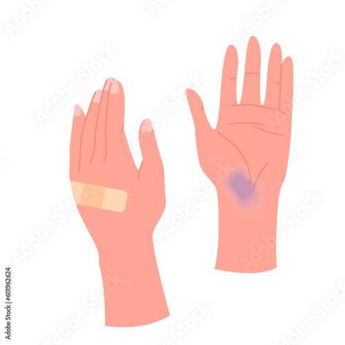 Human hands with band aid, bruise on palm, infographic vector illustration. Cartoon isolated two broken hands after injury or accident damage, medical adhesive tape for treatment of cut on arms skin