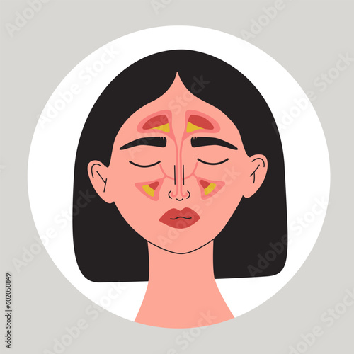 Young women suffering from a sinusitis. Female with health problem. Inflammation of mucous membrane of paranasal and frontal sinuses. Flat vector medical illustration