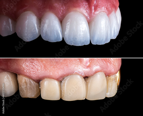 creating new smile with emax crowns and veneers bl2 color