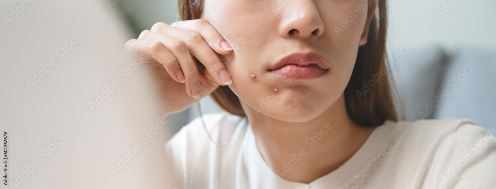 Asian young woman worry about acne on her face after wear face mask. Asian young woman worry about acne on her face after wear face mask.