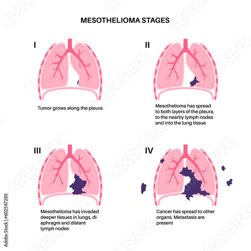 Mesothelioma cancer stages