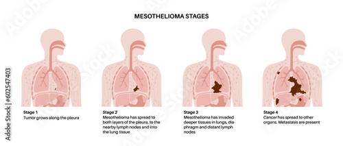 Mesothelioma cancer stages photo