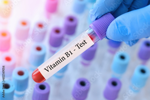 Doctor holding a test blood sample tube with Vitamin B1 test on the background of medical test tubes with analyzes.Banner.Copy space for text