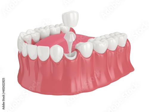 3d render of lower jaw with post and core tooth restoration