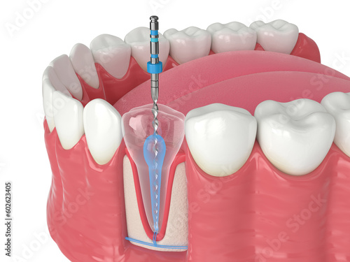 3d render of lower jaw with endodontic rotary file over white background photo