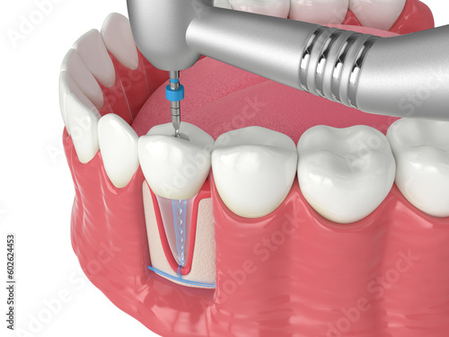 3d render of lower jaw with handpiece and endodontic rotary file over white background