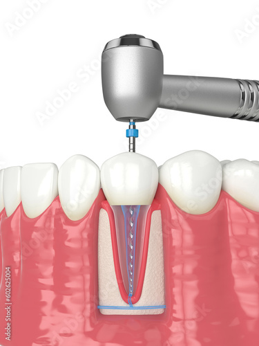 3d render of lower jaw with handpiece and endodontic rotary file over white background photo