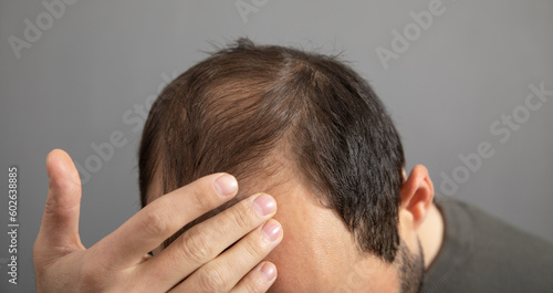 Caucasian man. Hair loss problem
