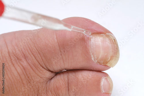 dermatologist, dermatovenereologist, podologist treats damaged rude nail on big toe of female foot, exfoliation, nail fungus, treatment Nail onycholysis, Paramedical, Medical pedicure, aging problems