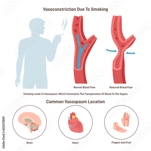 Arterial vasoconstriction. Normal and constricted blood vessels
