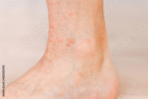 Close up allergic rash dermatitis eczema on man foot. Leg with red rash caused by insect bites. Dermatitis  folliculitis  fungal infection. Affected area of skin to turn red and blotchy and to swell