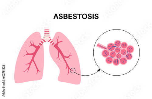 Asbestosis lung disease