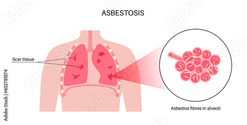 Asbestosis lung disease