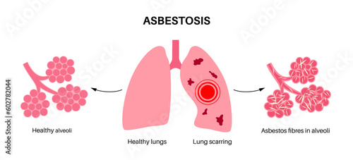 Asbestosis lung disease