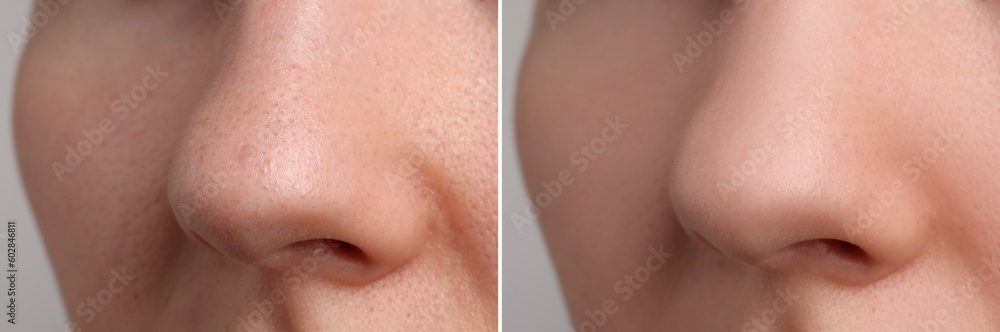Photos of woman before and after acne treatment, closeup. Collage showing affected and healthy skin Photos of woman before and after acne treatment, closeup. Collage showing affected and healthy skin
