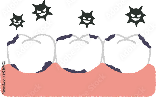 虫歯のイラスト