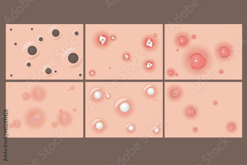 vector collection of types of pimples inside the skin Facial infections, pimples and skin inflammation. Skincare, face acne breakout. Dermatology epidermis