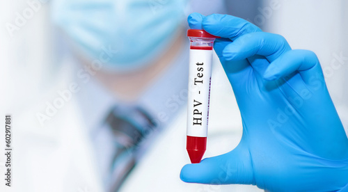 Doctor holding a test blood sample tube with HPV test.