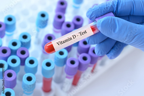 Doctor holding a test blood sample tube with Vitamin D test on the background of medical test tubes with analyzes