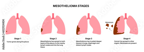 Mesothelioma cancer stages
