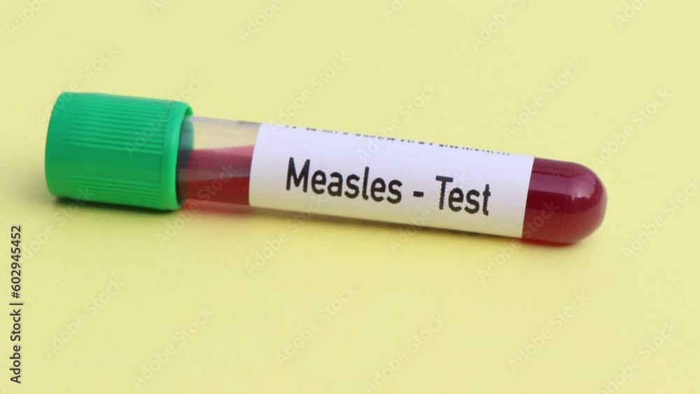 Measles test, blood sample to analyze in the laboratory, blood in test tube Measles test, blood sample to analyze in the laboratory, blood in test tube