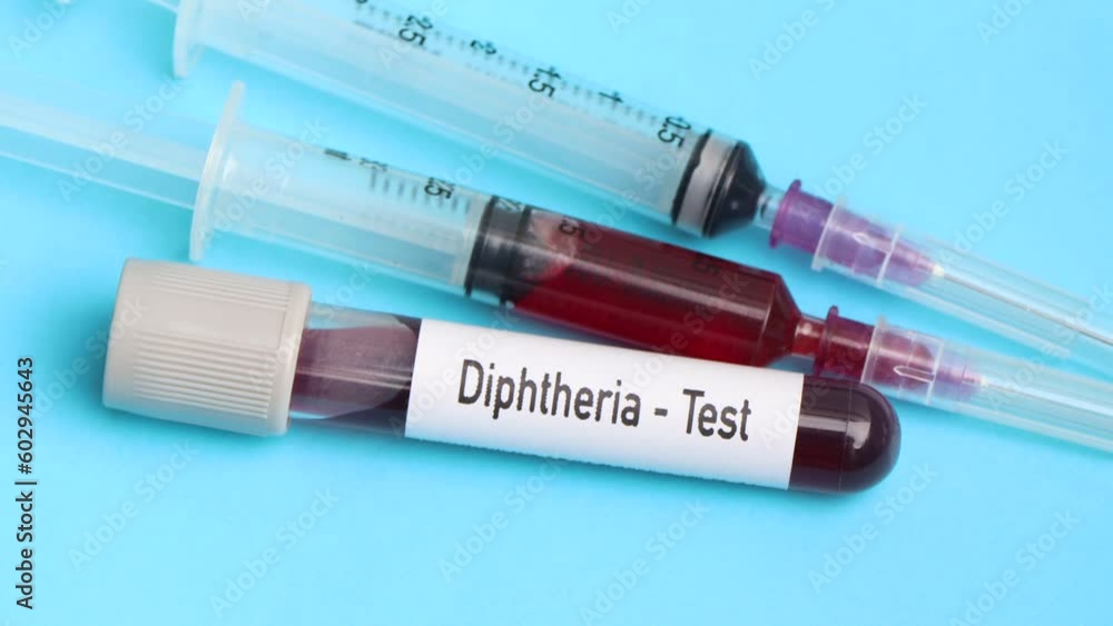 Diphtheria test, blood sample to analyze in the laboratory, blood in test tube Diphtheria test, blood sample to analyze in the laboratory, blood in test tube