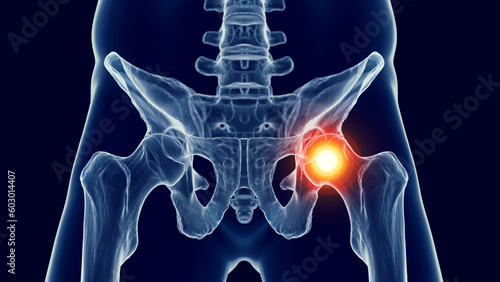3d medical illustration of a man's pelvis. hip pain