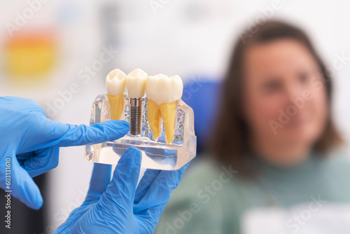 фотографія dental implants, dentist discussing a treatment plan with patient holds a dental implant model, emphasizing the importance of patient education in modern dental clinics