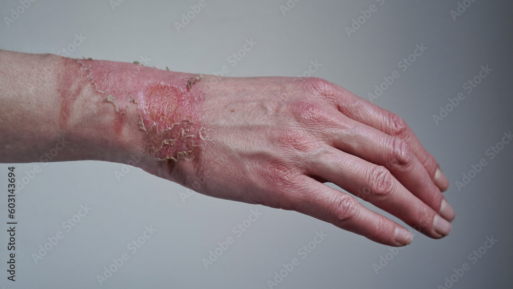 Close-up of a woman's hand with a burst blister from a boiled water burn, broken skin, 1st or 2nd degree burn. Painful wound. Thermal burn. Skin peels off after a burn, wound treatment. macro photo Close-up of a woman's hand with a burst blister from a boiled water burn, broken skin, 1st or 2nd degree burn. Painful wound. Thermal burn. Skin peels off after a burn, wound treatment. macro photo