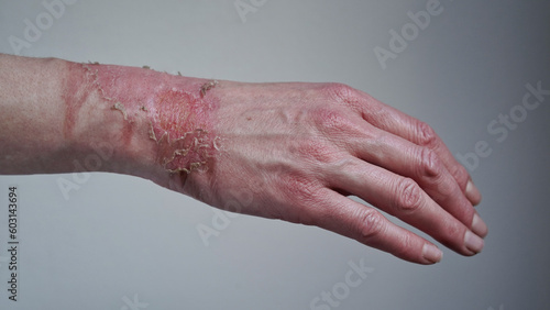 Close-up of a woman's hand with a burst blister from a boiled water burn, broken skin, 1st or 2nd degree burn. Painful wound. Thermal burn. Skin peels off after a burn, wound treatment. macro photo