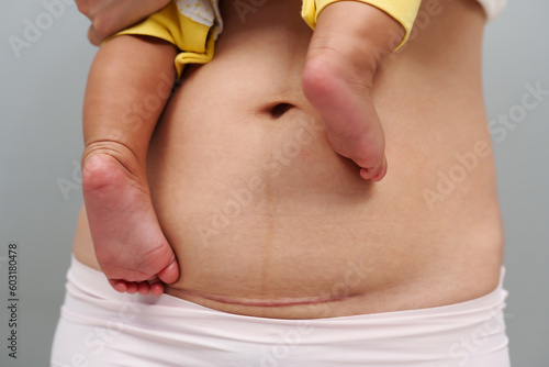 belly of woman with c-section scar of caesarean. mother holding her baby