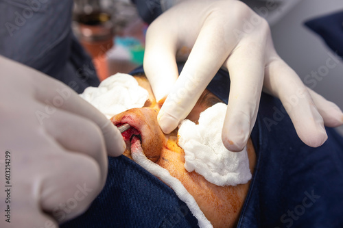 A cosmetic surgeon uses a nasal rasp to level out the bony surface prior to a PTFE implant and cartilage tip plasty photo