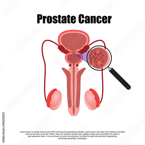 Prostatitis normal and inflamed prostate isolated vector